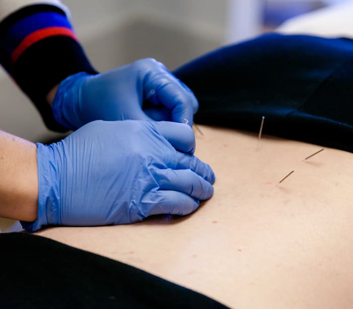 Acupuncture-dry-needling-ottawa-physiotherpay